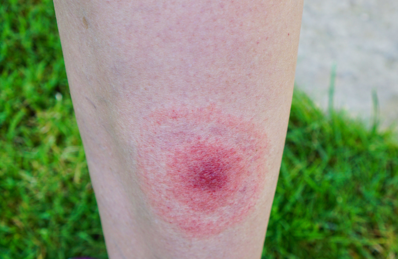 Lyme Disease: The Ultimate Guide - AmeriPharma Specialty Care