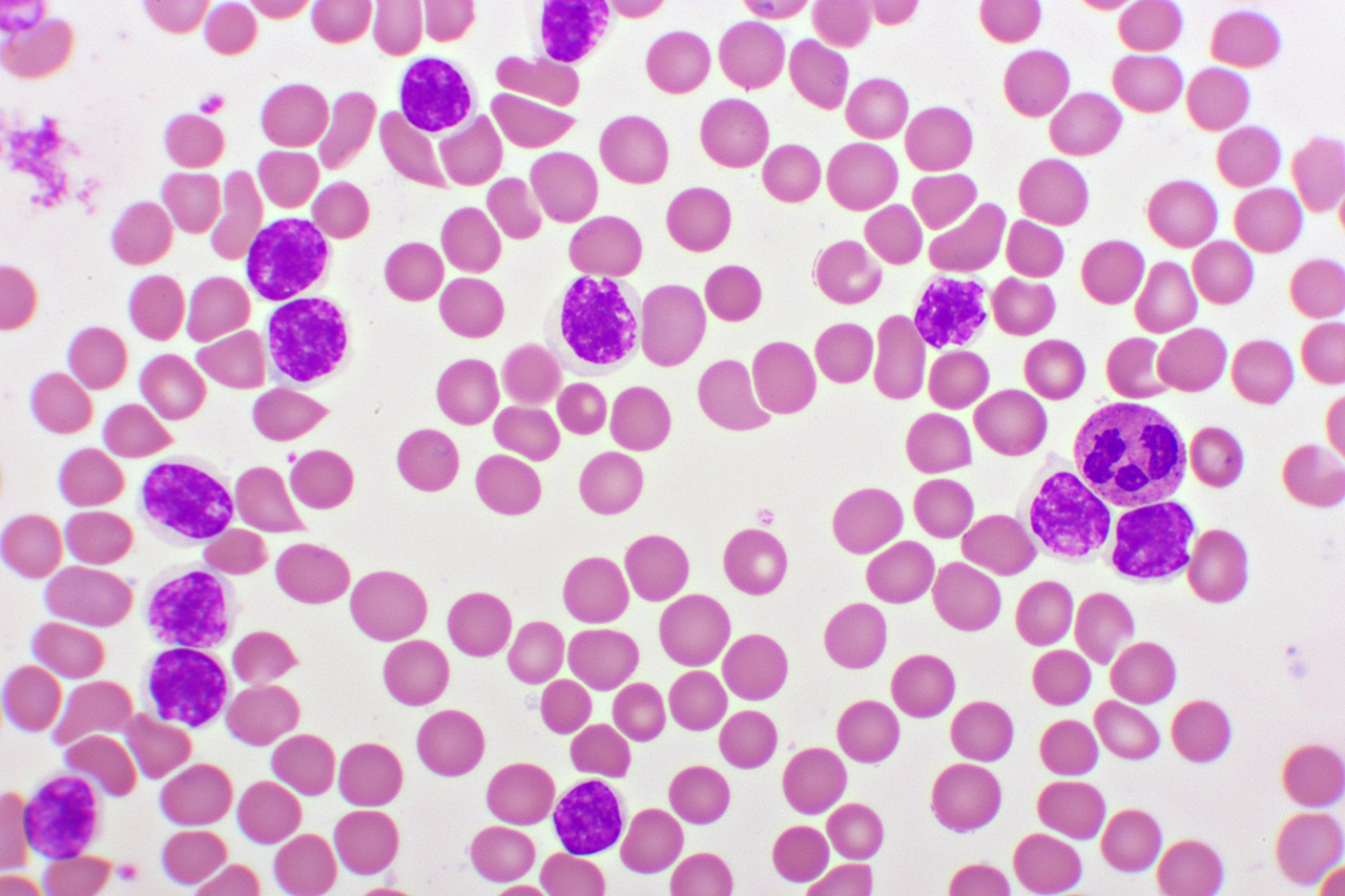 Chronic Lymphoid Leukemia Treatment SFSPF Chronic Lymphoid Leukemia Treatment SFSPF