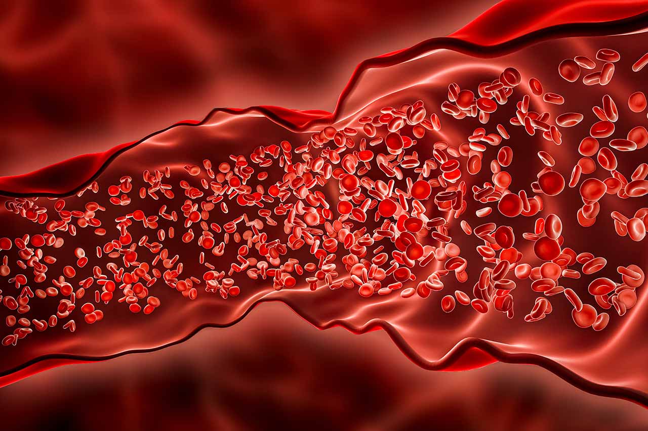 Blood flowing through artery of hemophilia patient