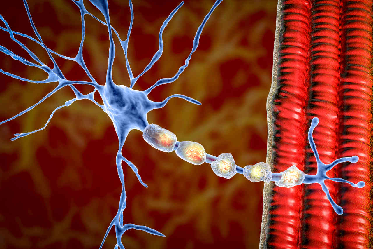 Demyelination of a neuron in MS