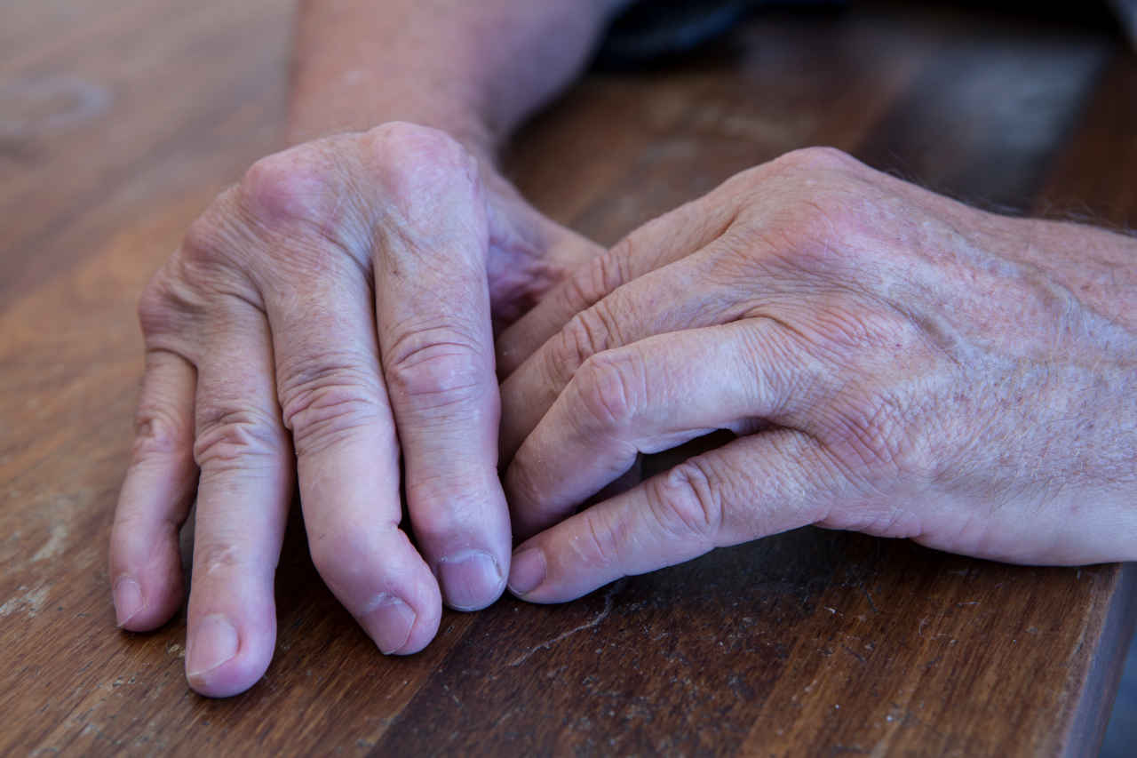 The hands of a man with psoriatic arthritis on a wooden table,