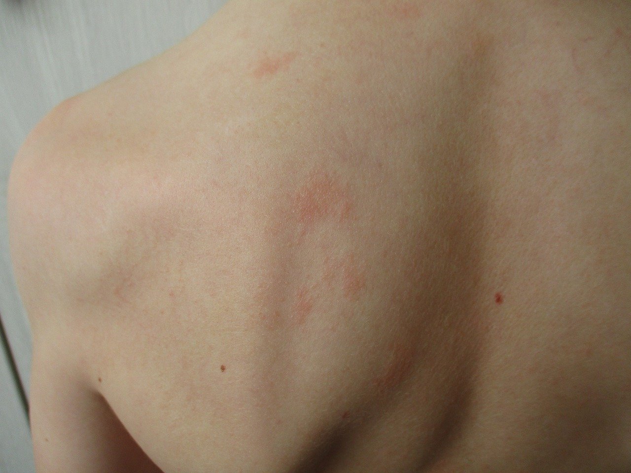 Dermatomyositis skin rashes