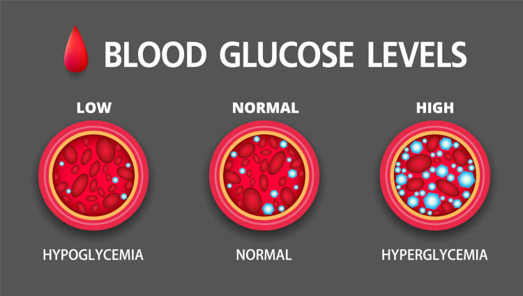 Visual representation showing blood glucose levels for hypoglycemia, normal and hyperglycemia