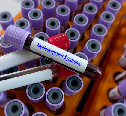 Blood sample for Myelodysplastic syndrome test