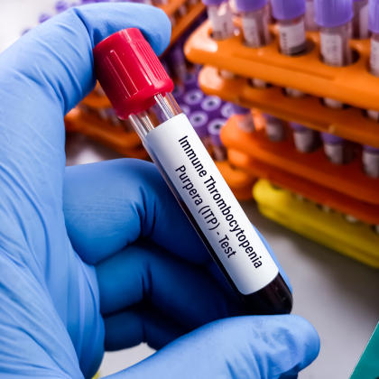 Blood sample for Immune Thrombocytopenic Purpura (ITP) test