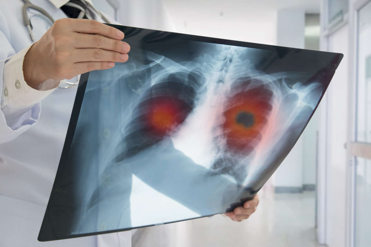 Doctor looking at x-ray of lung cancer patient