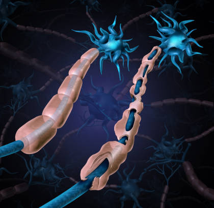 3D illustration of damaged myelin sheath from CIDP