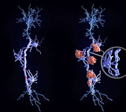 Microglia cells attack the oligodendrocytes that form the insulating myelin sheath