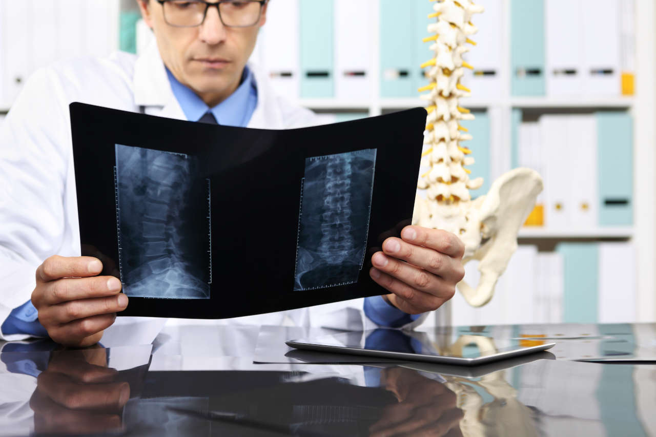 Radiologist doctor checking x-ray for patient with ankylosing spondylitis