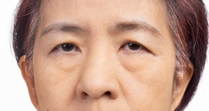 Seronegative myasthenia gravis patient with droopy eyelids