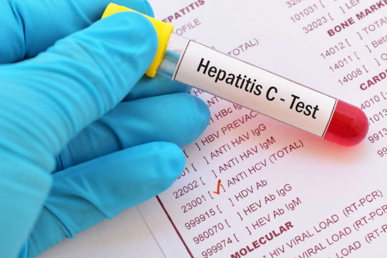 Test tube with blood sample for hepatitis C virus (HCV) test