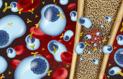 Multiple myeloma concept illustration