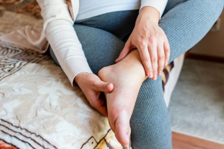 Woman with IVIG fluid retention in her left foot