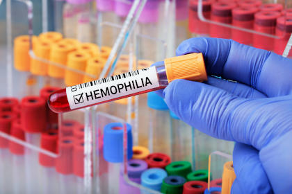 Blood sample with positive diagnosis of Hemophilia