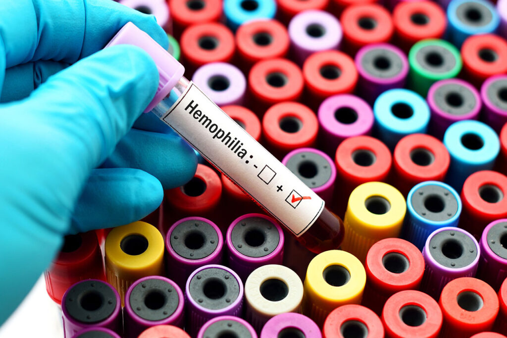 A gloved hand holding a hemophilia-positive test tube