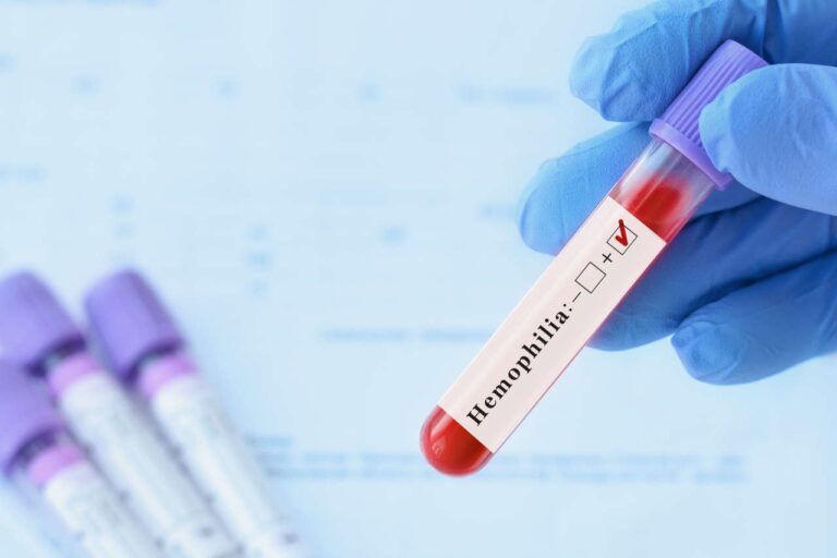 A gloved hand holding a blood sample tube with a hemophilia positive label