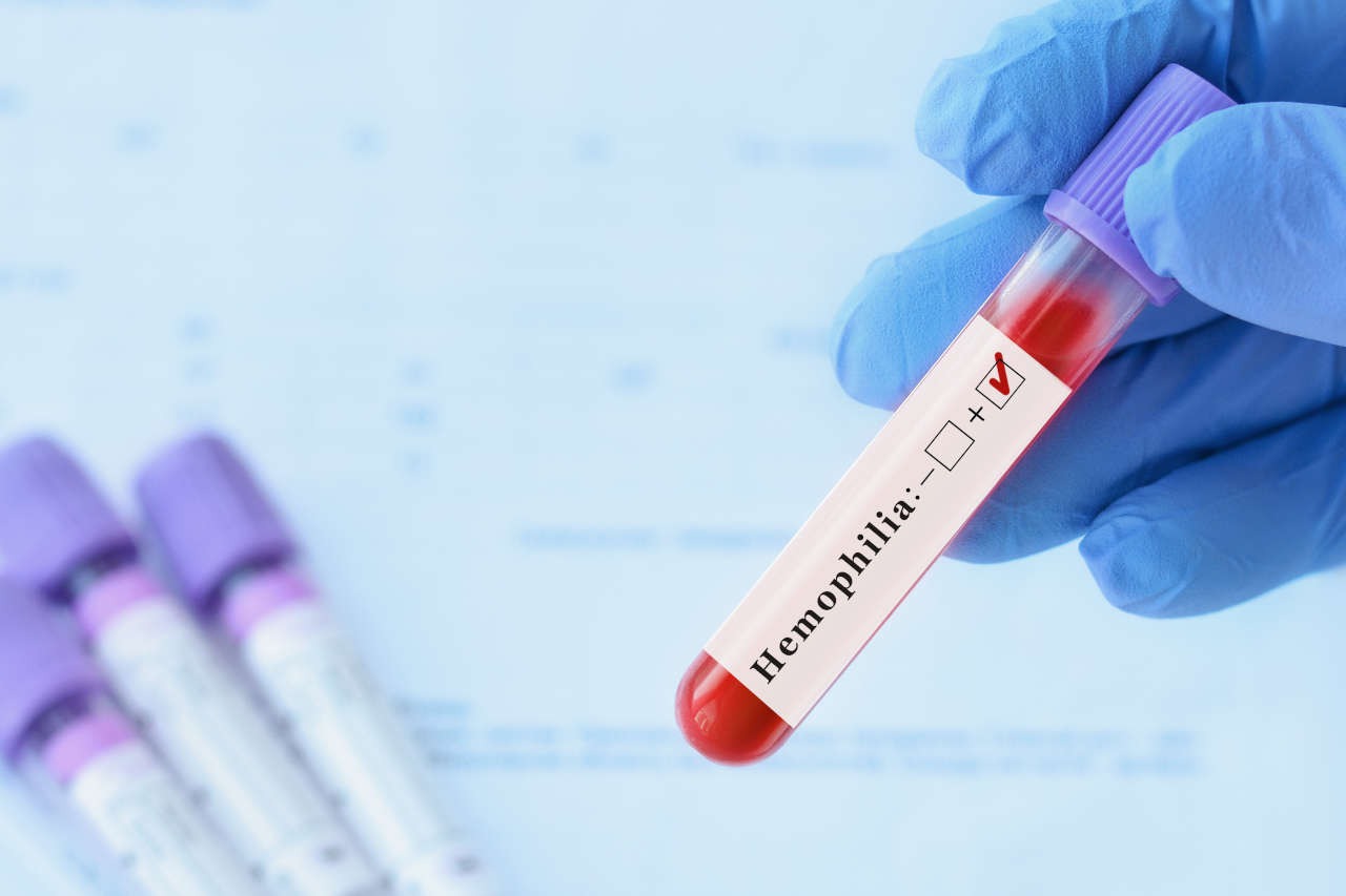 A gloved hand holding a blood sample tube with a hemophilia positive label