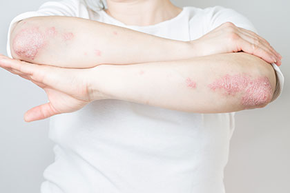 Illumya patient suffering from plaque psoriasis