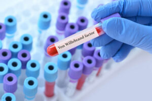 Doctor holding a test blood sample tube with Von Willebrand Factor Test on the background of medical test tubes.